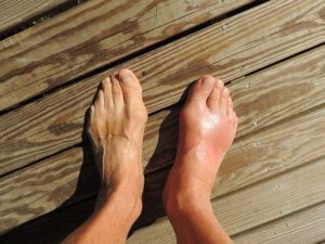 Feet with Gout can be prevented with 5 simple diet changes