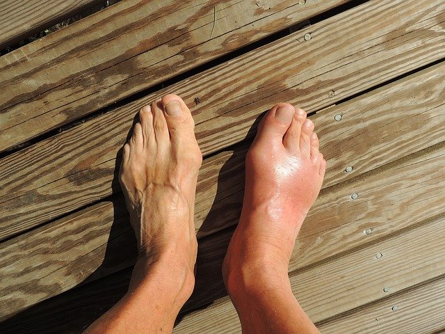 Feet with Gout